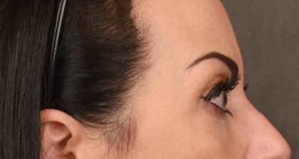 Blepharoplasty Before & After Patient #3131