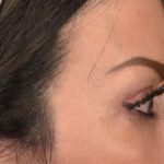 Blepharoplasty Before & After Patient #3131