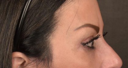 Blepharoplasty Before & After Patient #3131