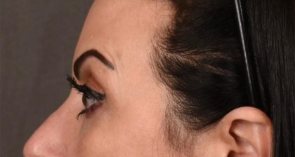 Blepharoplasty Before & After Patient #3131