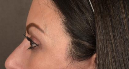 Blepharoplasty Before & After Patient #3131