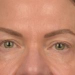 Blepharoplasty Before & After Patient #3132