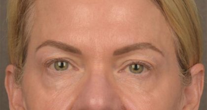Blepharoplasty Before & After Patient #3132