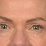 Blepharoplasty Before & After Patient #3132