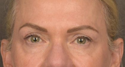 Blepharoplasty Before & After Patient #3132