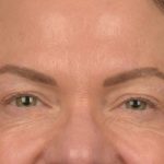 Blepharoplasty Before & After Patient #3132