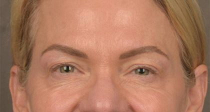 Blepharoplasty Before & After Patient #3132
