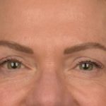 Blepharoplasty Before & After Patient #3132