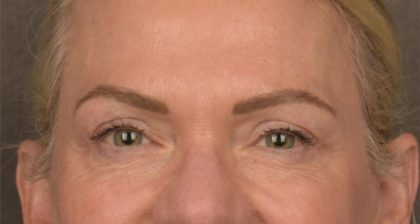 Blepharoplasty Before & After Patient #3132