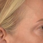 Blepharoplasty Before & After Patient #3132