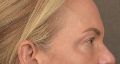 Blepharoplasty Before & After Patient #3132