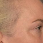 Blepharoplasty Before & After Patient #3132