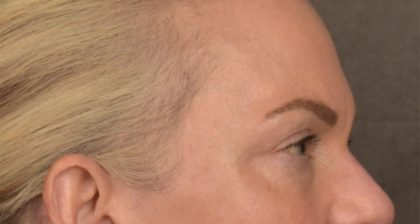 Blepharoplasty Before & After Patient #3132