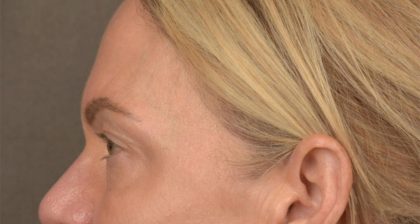 Blepharoplasty Before & After Patient #3132