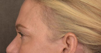 Blepharoplasty Before & After Patient #3132