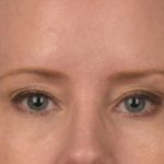 Blepharoplasty Before & After Patient #3134