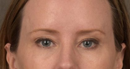 Blepharoplasty Before & After Patient #3134