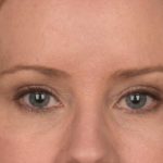 Blepharoplasty Before & After Patient #3134