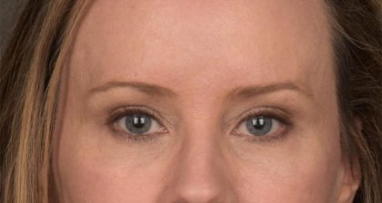 Blepharoplasty Before & After Patient #3134