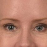 Blepharoplasty Before & After Patient #3134