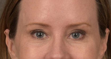 Blepharoplasty Before & After Patient #3134