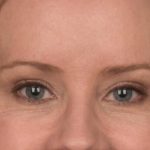 Blepharoplasty Before & After Patient #3134