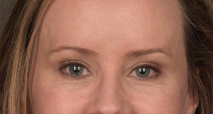 Blepharoplasty Before & After Patient #3134