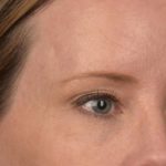 Blepharoplasty Before & After Patient #3134
