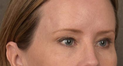 Blepharoplasty Before & After Patient #3134