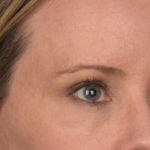 Blepharoplasty Before & After Patient #3134