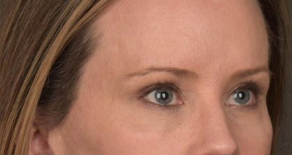 Blepharoplasty Before & After Patient #3134