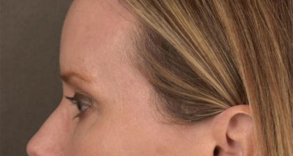 Blepharoplasty Before & After Patient #3134