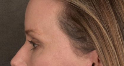 Blepharoplasty Before & After Patient #3134