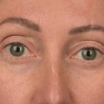 Blepharoplasty Before & After Patient #3135