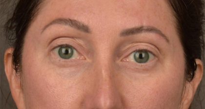 Blepharoplasty Before & After Patient #3135