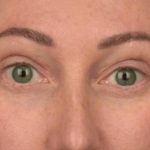 Blepharoplasty Before & After Patient #3135
