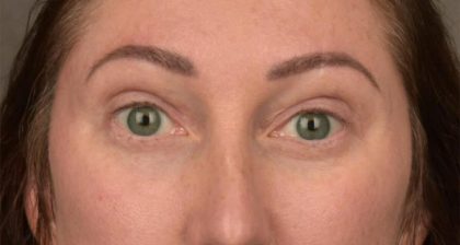 Blepharoplasty Before & After Patient #3135