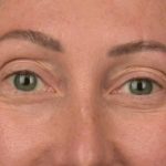 Blepharoplasty Before & After Patient #3135