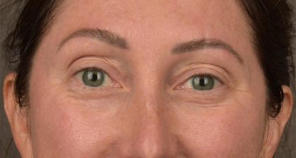 Blepharoplasty Before & After Patient #3135
