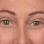 Blepharoplasty Before & After Patient #3135