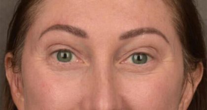 Blepharoplasty Before & After Patient #3135