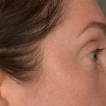 Blepharoplasty Before & After Patient #3135