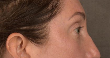 Blepharoplasty Before & After Patient #3135