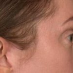 Blepharoplasty Before & After Patient #3135