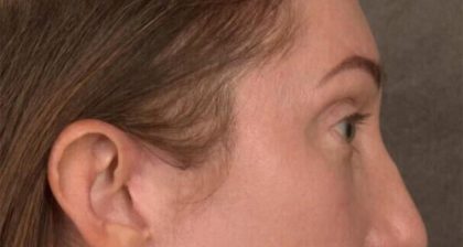 Blepharoplasty Before & After Patient #3135