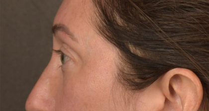 Blepharoplasty Before & After Patient #3135