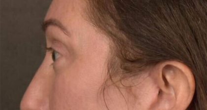 Blepharoplasty Before & After Patient #3135