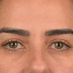 Blepharoplasty Before & After Patient #3136