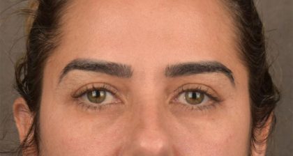Blepharoplasty Before & After Patient #3136