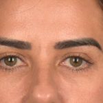 Blepharoplasty Before & After Patient #3136